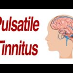Pulsatile Tinnitus: 7 Different Anatomic Causes of Hearing Pulsations in the Ear